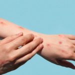 Šta je virus chikungunya koji se širi svijetom i izaziva globalnu zabrinutost?