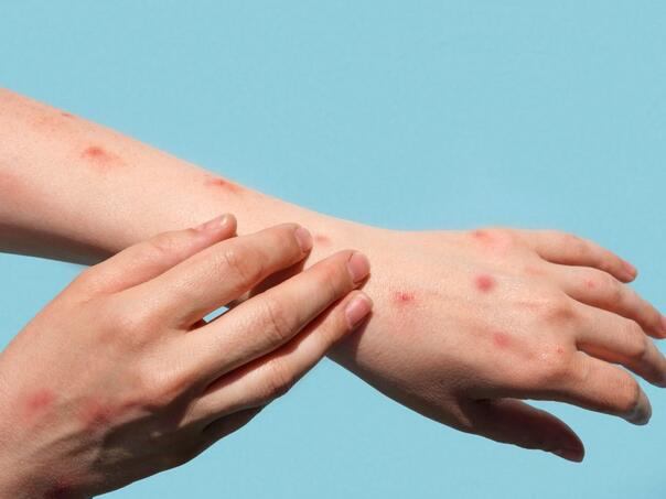 Šta je virus chikungunya koji se širi svijetom i izaziva globalnu zabrinutost?